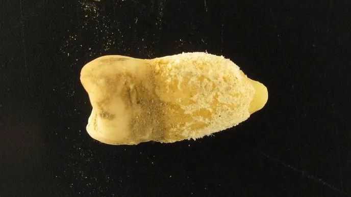 Un batterio scoperto su un dente di mummia boliviana riscrive la storia della scarlattina e oltre