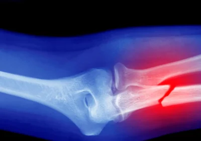 Osteoporosi, cosa si può fare per allievare una malattia cronica sempre più diffusa con l’invecchiamento della popolazione italiana