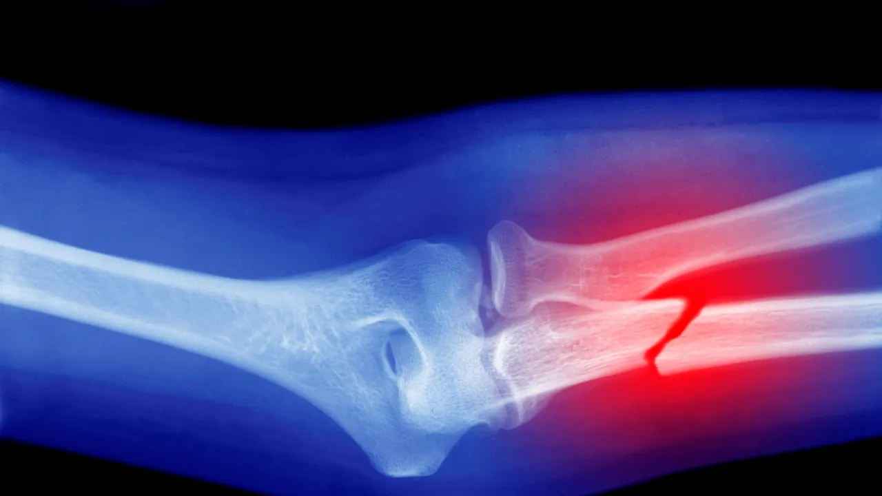 Osteoporosi, cosa si può fare per allievare una malattia cronica sempre più diffusa con l’invecchiamento della popolazione italiana